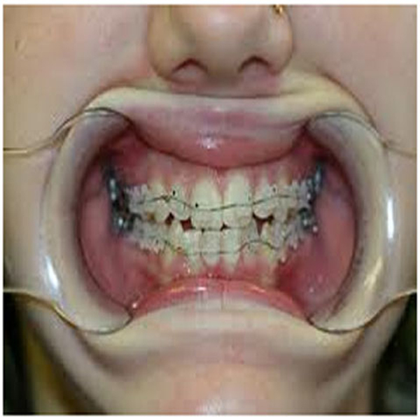 Nonextraction orthodontics